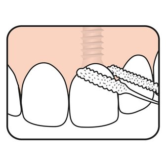 Tepe Implant Floss