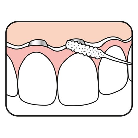 Tepe Implant Floss